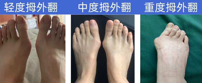 拇外翻从轻到重发展示意图